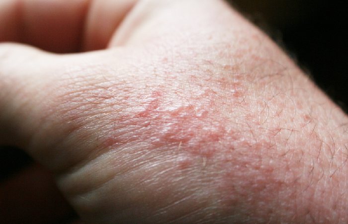 Common Skin Disease in the Summer