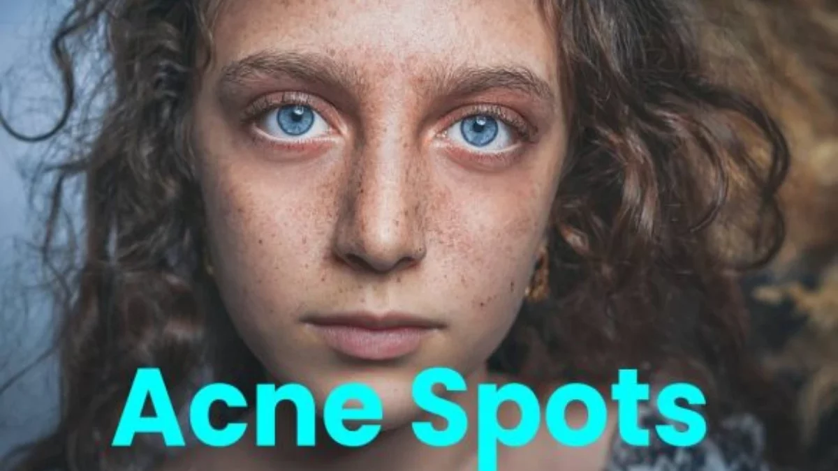 About – Acne Spots Types, Remedies, and More