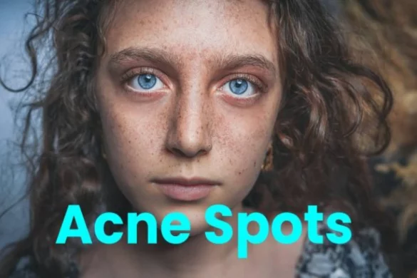About - Acne Spots Types, Remedies, and More