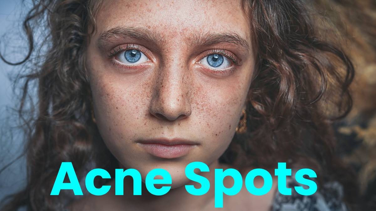 Acne Spots – About, Types, Remedies, and More