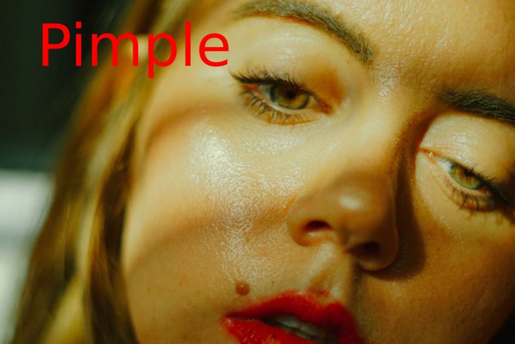Pimple