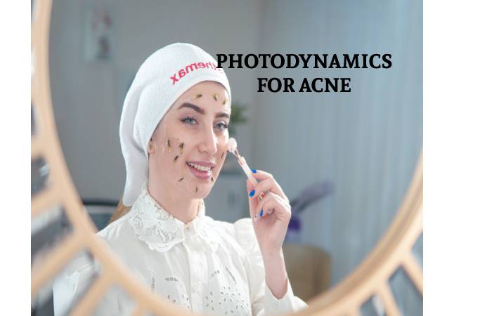 PHOTODYNAMICS FOR ACNE