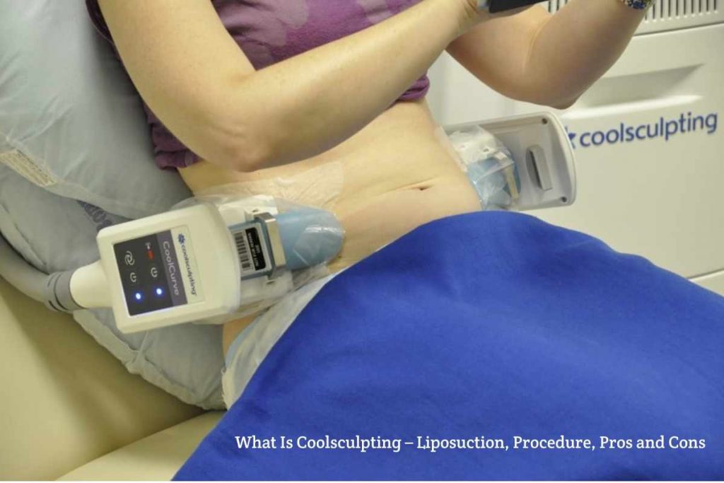 What Is Coolsculpting