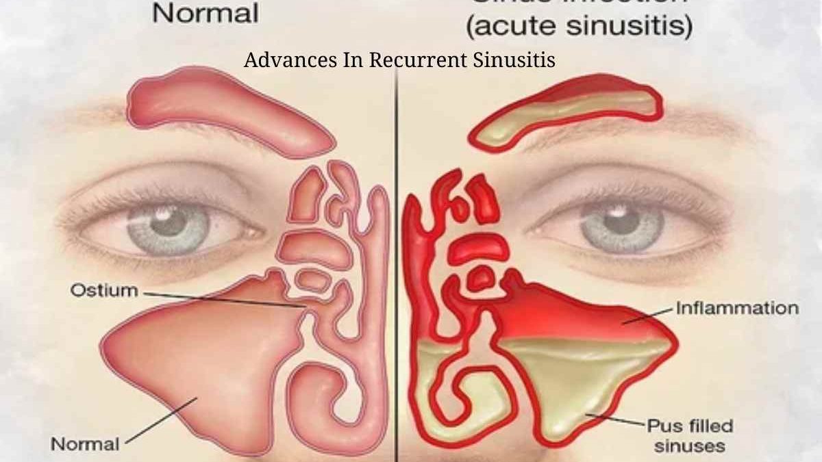 Advances In Recurrent Sinusitis Management