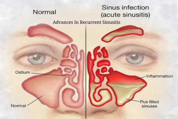 Advances In Recurrent Sinusitis Management