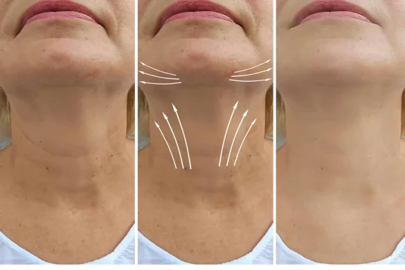 Treatment Options To Combat Saggy Neck