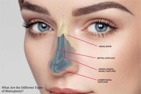 What Are the Different Types of Rhinoplasty