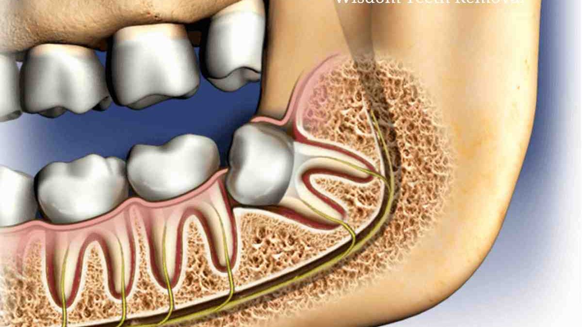 Wisdom Teeth Removal