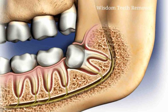 Wisdom Teeth Removal