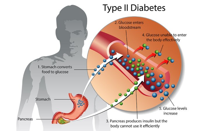 Type 2 Diabetes