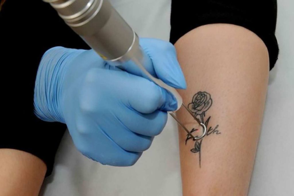 Top Tattoo Removal Tips You Need