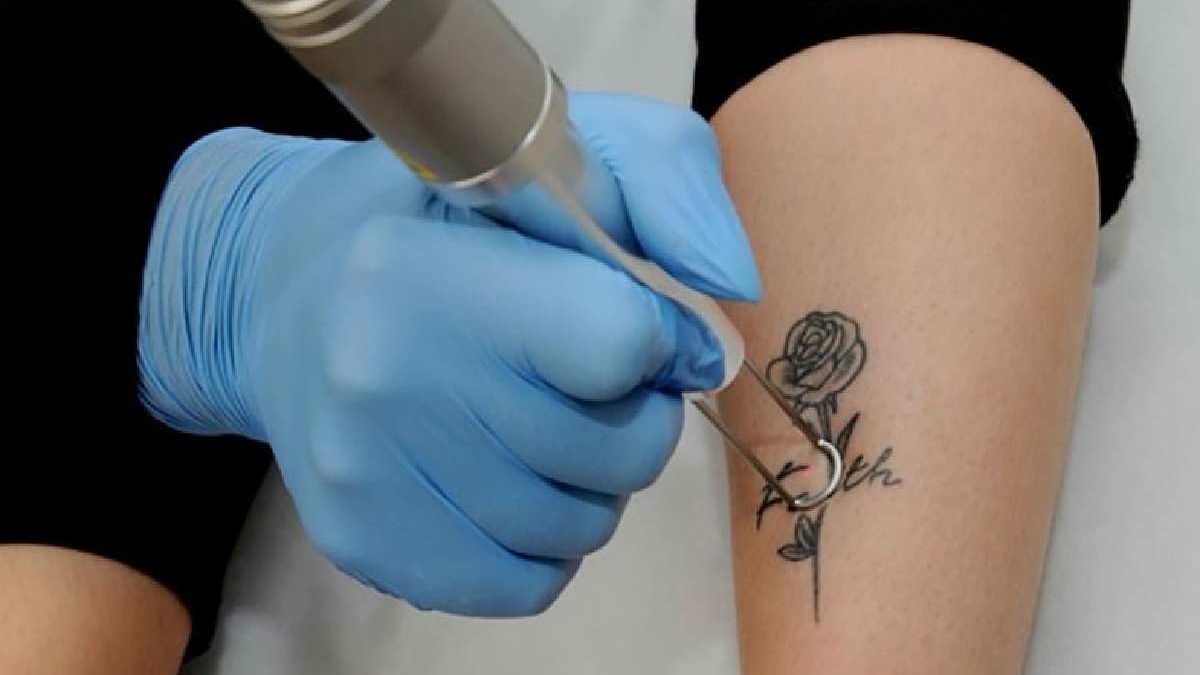 Saying Goodbye to Ink Regret: Top Tattoo Removal Tips You Need