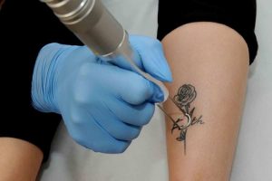 Top Tattoo Removal Tips You Need