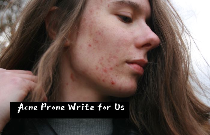acne prone write for us