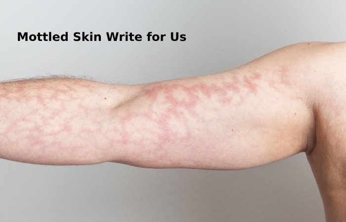 mottled skin write for us