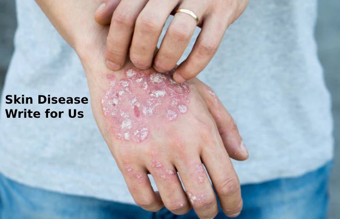 skin disease write for us