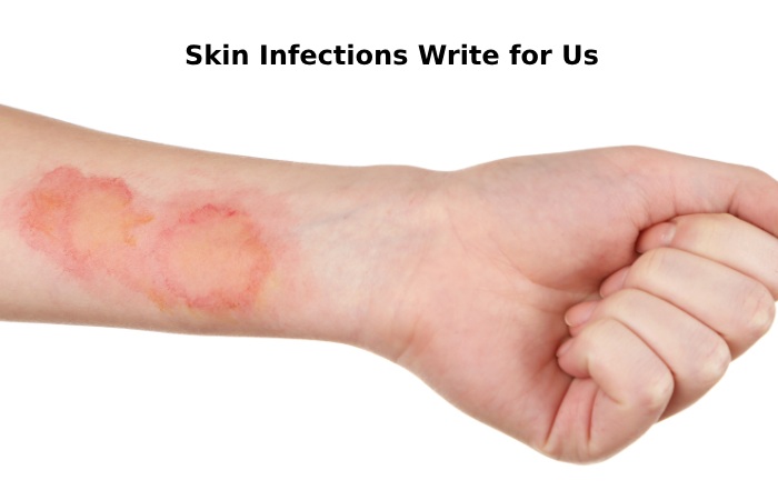 skin infections write for us