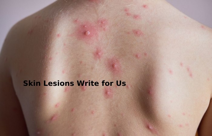 skin lesions write for us