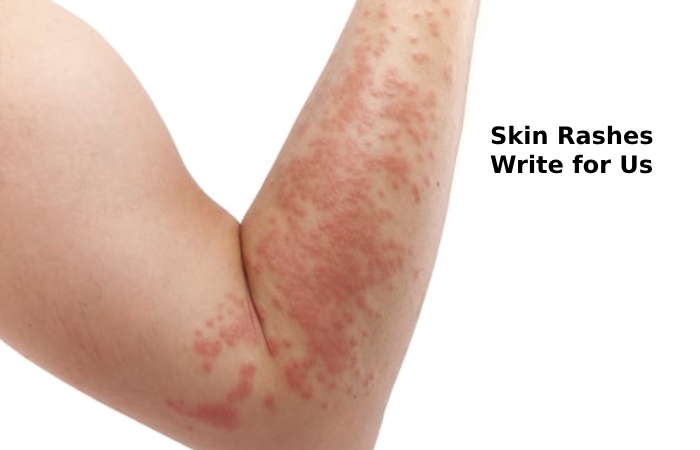 skin rashes write for us