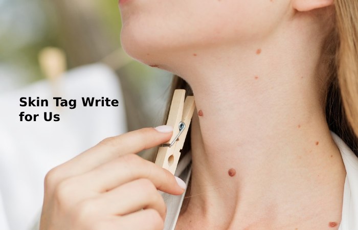 skin tag write for us