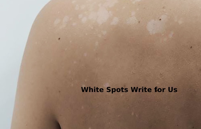 white spots write for us